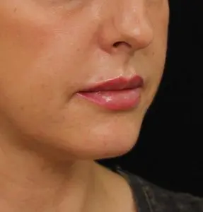 Lip-filler-after-