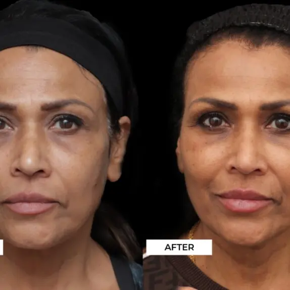 Cheek Filler Treatment