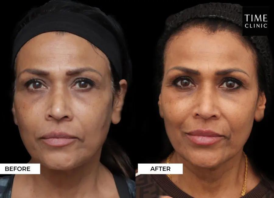 Cheek Filler Treatment