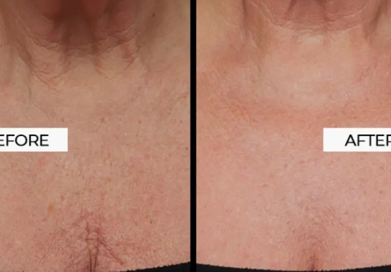 combining Secret RF Microneedling and Profhilo