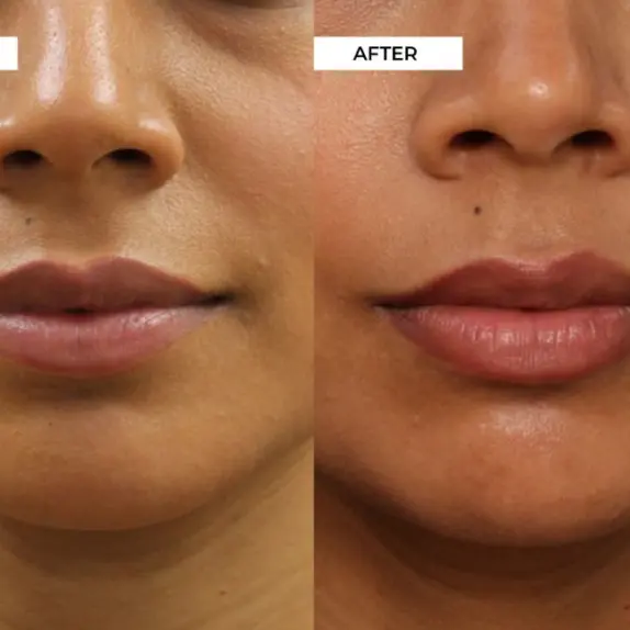 Lip Filler Treatment