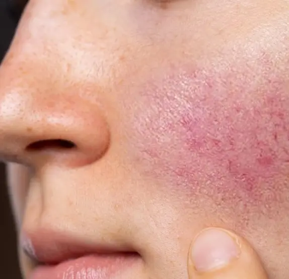 Rosacea