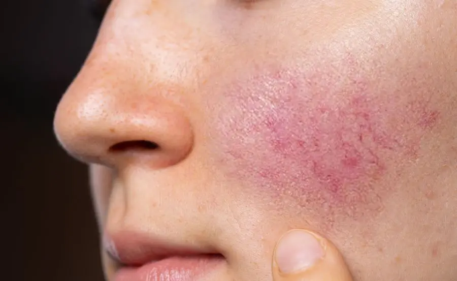 Rosacea