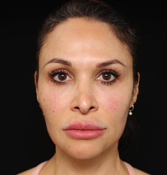 after anti wrinkle injectables