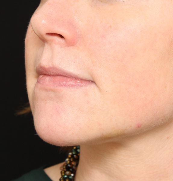 Chin-jawline-dermal-fillers-after-s