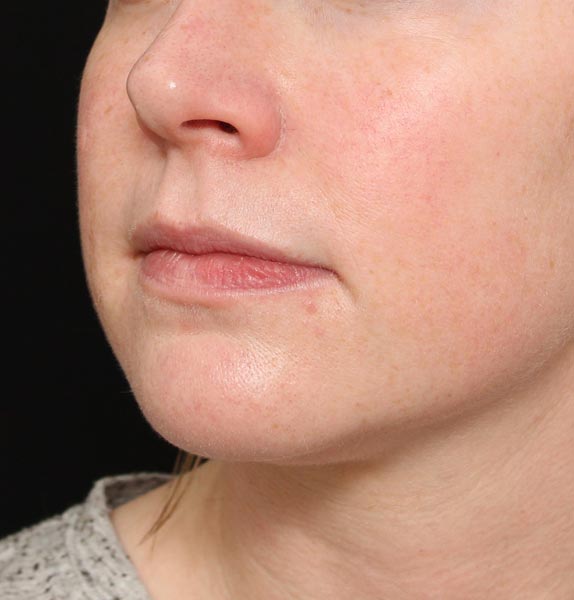 jawline dermal fillers before