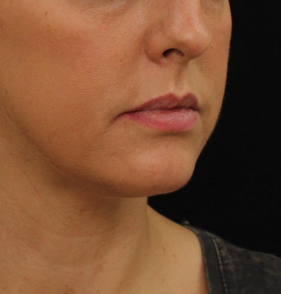 Lip-dermal-fillers-before