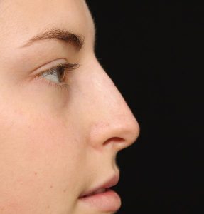 Nose-before-dermal-fillers-2