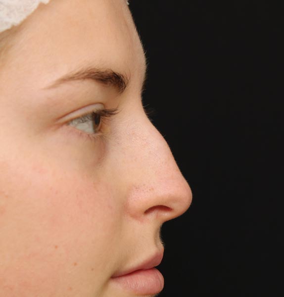 Nose-before-dermal-fillers