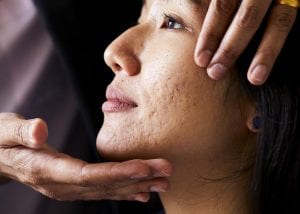 acne scars at time clinic essex