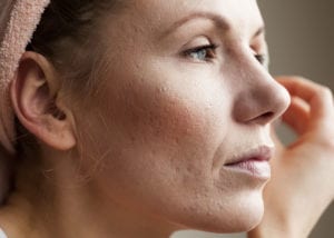 Acne Scar treatment essex