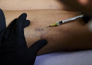 Sclerotherapy Loughton