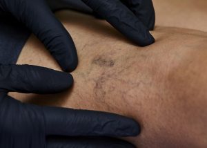 spider veins treatment London