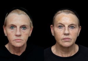 Non-Surgical Face Lift, Lisa's Johns Transformative Before and Afters