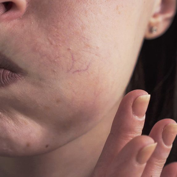 Facial Thread Veins