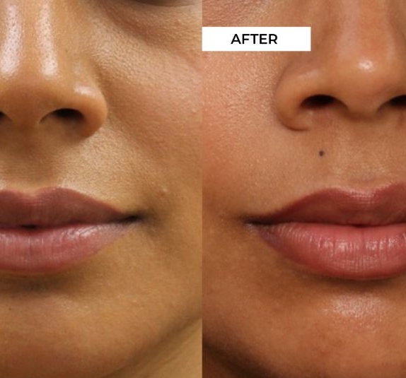 Lip Filler