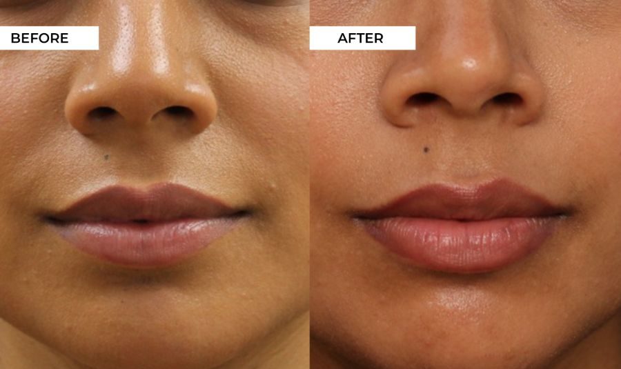 Lip Filler