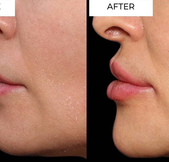 Chin Filler Treatment