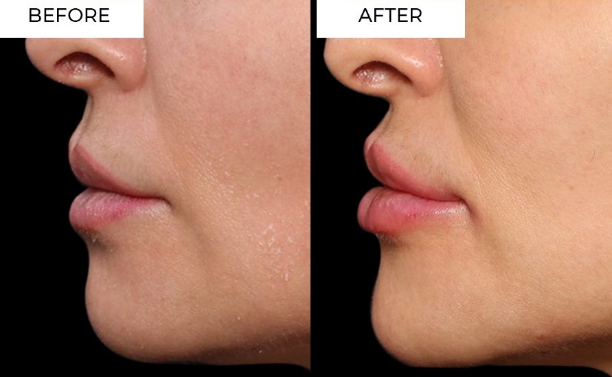 Chin Filler Treatment