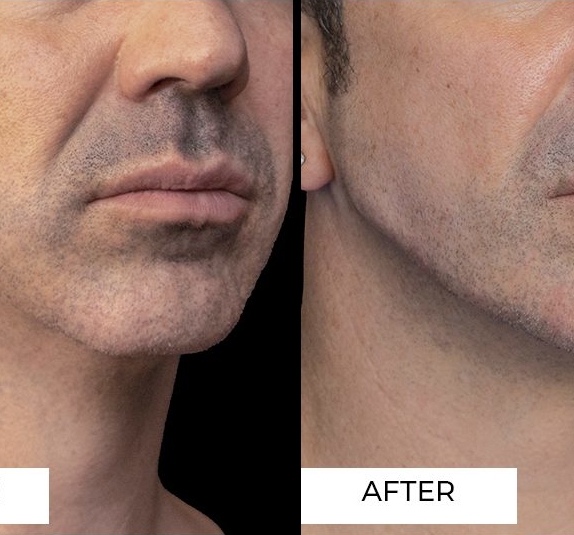 Jaw Filler Treatment