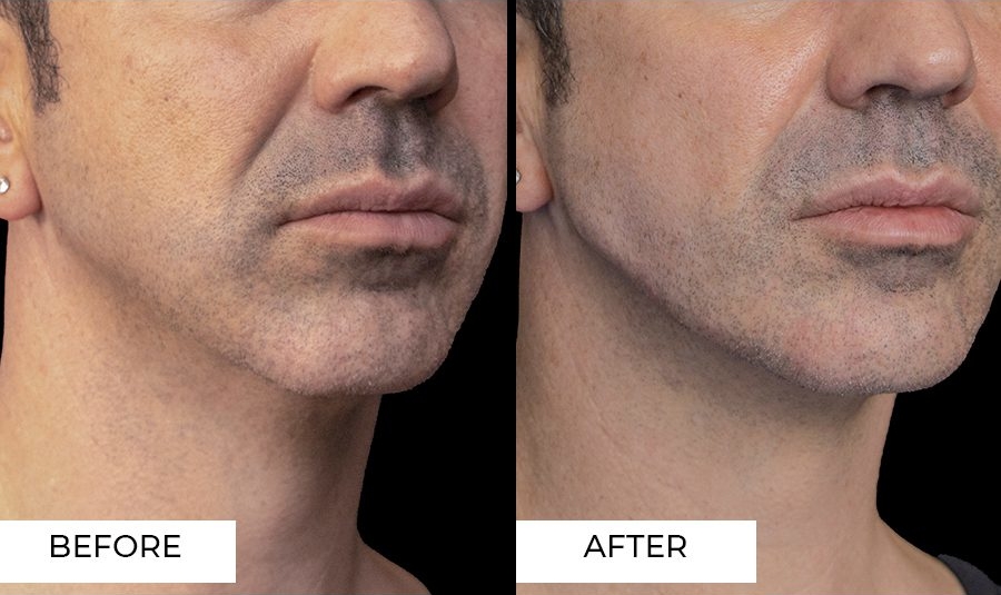Jaw Filler Treatment